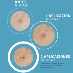 Iroha Parches SOS Granos Ácido Salicílico